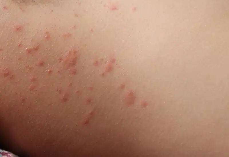 persona con bolle dovute all'allergia per gli acari della polvere