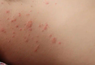 persona con bolle dovute all'allergia per gli acari della polvere