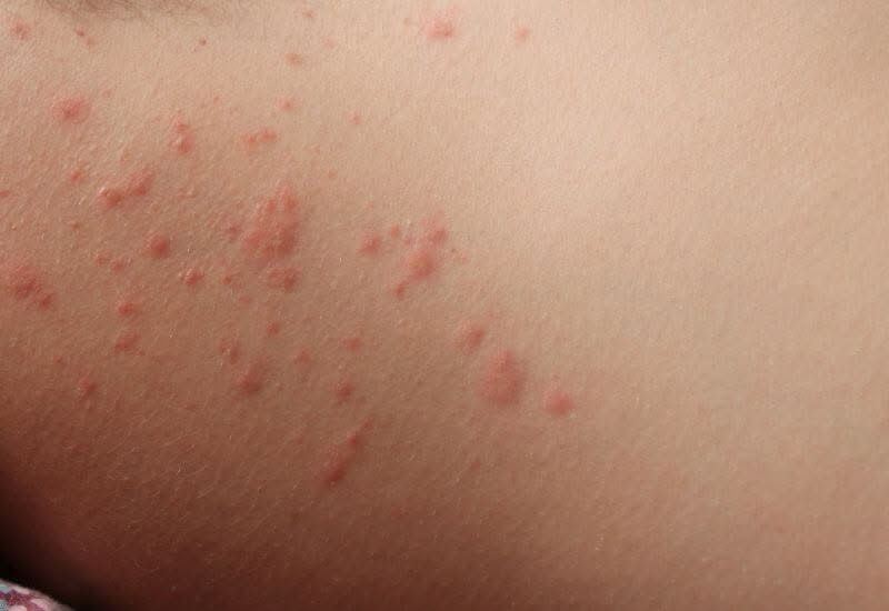 persona con bolle dovute all'allergia per gli acari della polvere